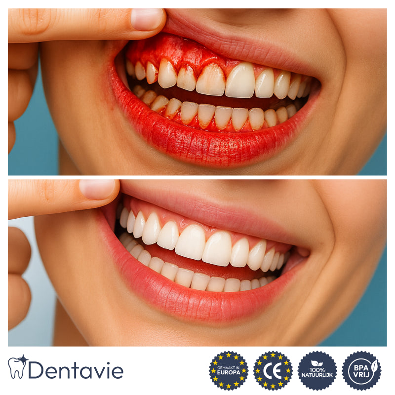Dentavie tandvleesherstelgel | Revitaliseert terugtrekkend tandvlees en maakt gele tanden in slechts 3 dagen